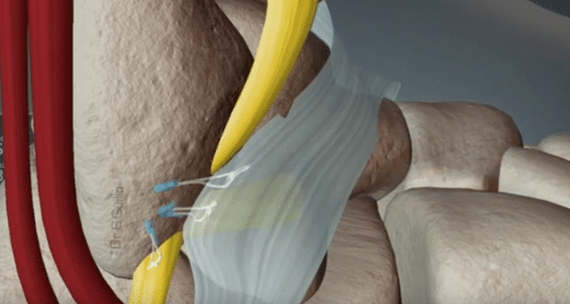 Instabilité chronique de la cheville : traitement par arthroscopie
