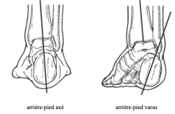 Anatomie du pied creux
