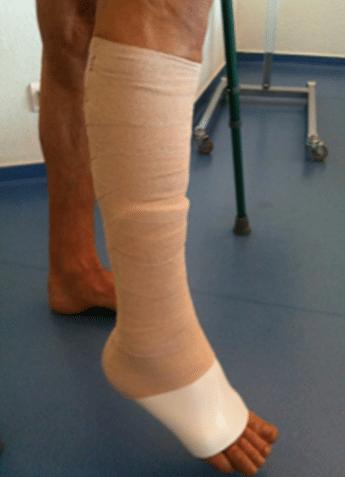 Rééducation après une chirurgie suite à rupture du tendon d'Achille