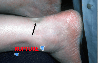 Rupture du tendon d'Achille du tendon d'Achille : causes, conséquences et traitement