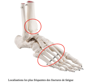 Fracture De Fatigue - SOS Pied Cheville