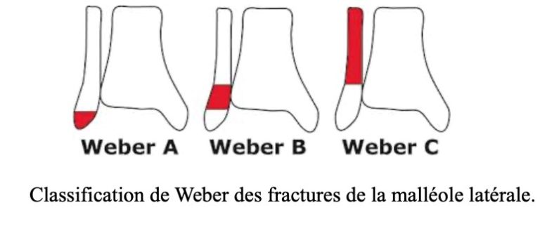 Fracture De Cheville - SOS Pied Cheville