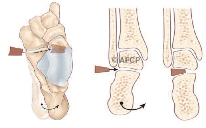 Traitement du pied plat : l’arthrorise par implant dans le sinus du tarse