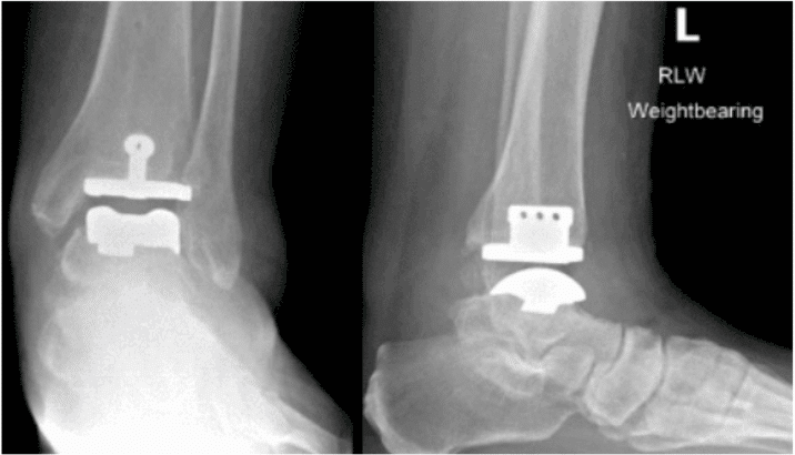 Prothèse de cheville : arthroplastie, les techniques opératoires