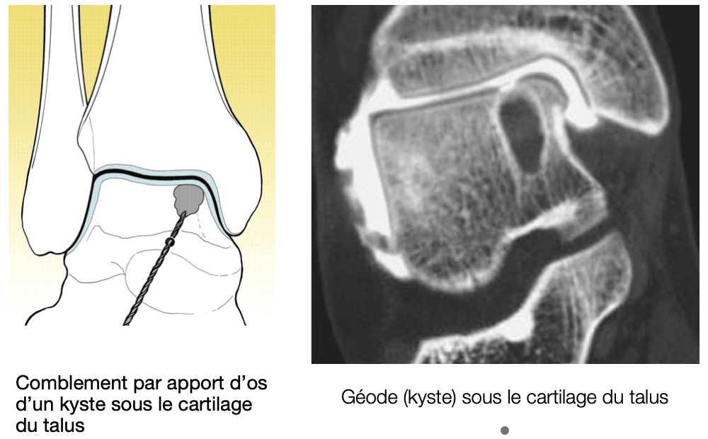 Traitement chirurgical du cartilage : relèvement et greffe