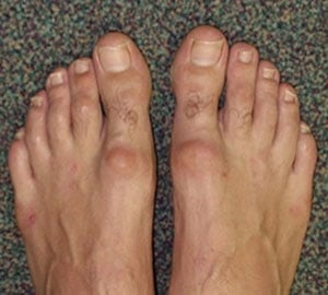 hallux rigidus