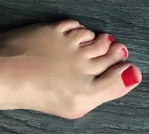 hallux valgus pied