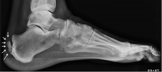 Radiographie d'une enthésopathie calcifiante