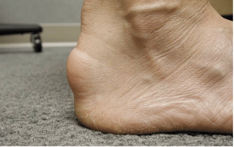 Photo d'une enthésopathie calcifiante