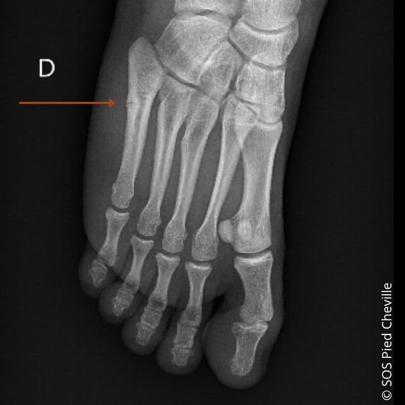 La fracture de Jones fait partie des fractures du cinquième métatarsien.