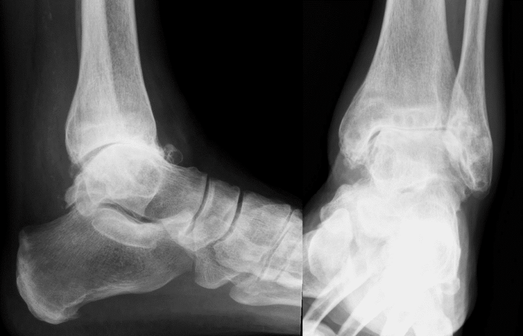 Radiographies de profil et de face d’une arthrose sévère de la cheville : pincement de l’interligne et ostéophytes