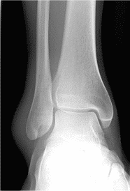 Radiographie de face d’une cheville saine, avec un interligne articulaire régulier