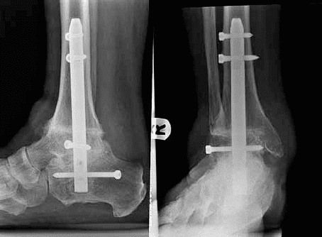 Radiographies de face et de profil d’une arthrodèse de cheville fixée par un clou verrouillé