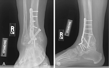 Radiographies de face et de profil d’une arthrodèse de cheville par voie antérieure, fixée par vis