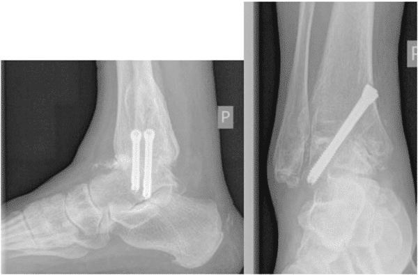 Radiographies de profil et de face d’une arthrodèse de cheville réalisée sous arthroscopie et fixée par deux vis