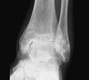 Radiographie de face d’une cheville arthrosique