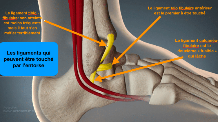 Vue latérale de la cheville : le ligament talo-fibulaire antérieur est le premier touché, le calcanéo-fibulaire le deuxième, le tibio-fibulaire plus rarement