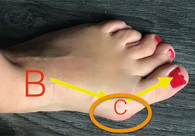 Photographie d’un avant-pied atteint d’hallux valgus : le gros orteil dévié vers l’extérieur (B) et la boule formée sur le côté par la tête du métatarsien (C)