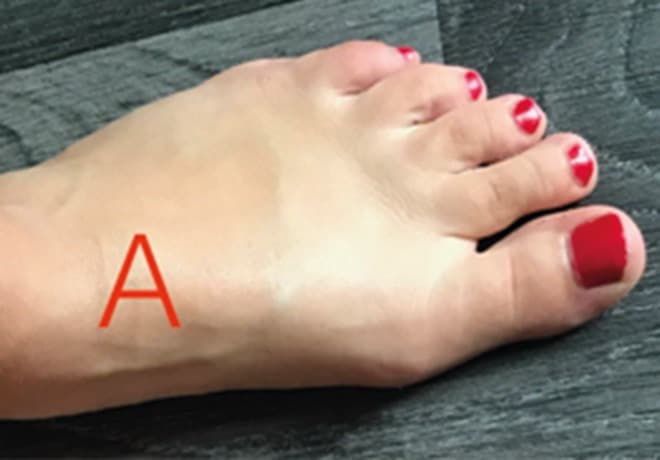 Photographie d’un avant-pied vu de dessus, gros orteil dans son axe, repère A