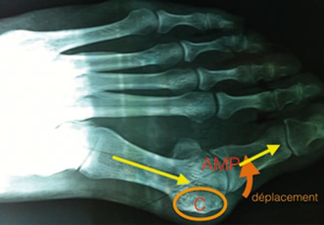 Radiographie de face d’un avant-pied avec hallux valgus : la tête du métatarsien déplacée vers la peau forme la boule sur le côté (C), au niveau de l’articulation métatarso-phalangienne (AMP)
