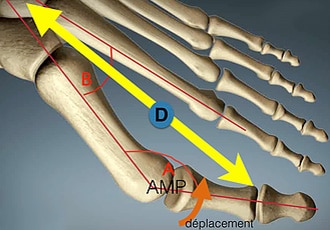 Schéma du squelette de l’avant-pied : l’angle A mesure l’hallux valgus, l’angle B le metatarsus varus, la flèche jaune (D) figure la force des tendons qui entretient la déformation