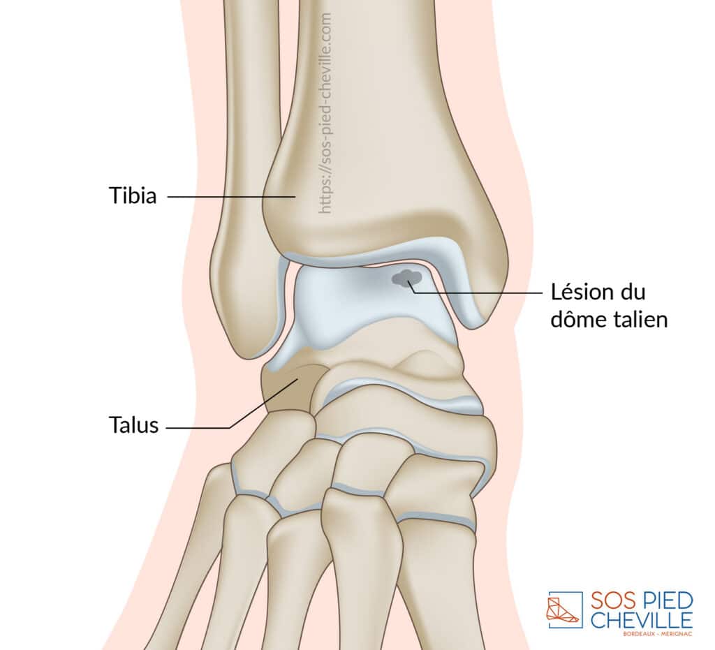 Schéma de la cheville de face : la lésion du cartilage sur le dôme du talus, sous la surface articulaire du tibia