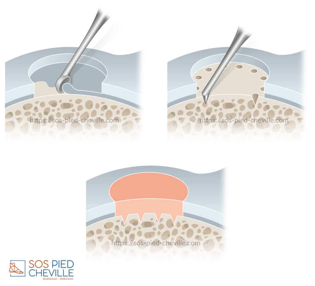 Schémas du geste chirurgical : curetage de la lésion cartilagineuse, perforations de l’os sous-chondral, puis comblement de la perte de substance