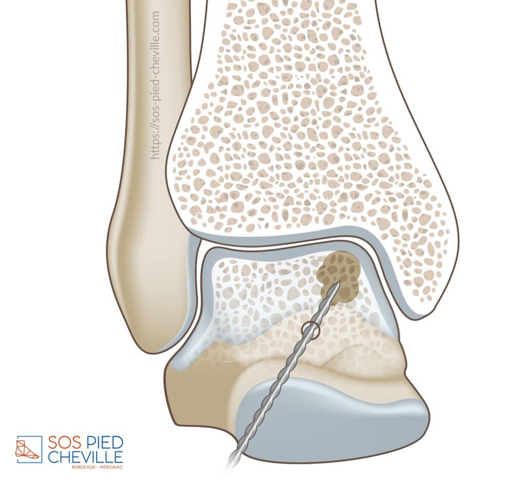Schéma d’un kyste sous-chondral du talus, atteint par une perforation depuis la surface articulaire