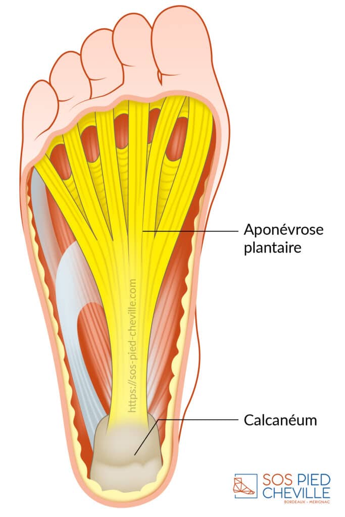 Schéma de la plante du pied : l’aponévrose plantaire, figurée en jaune, tendue du calcanéum vers les orteils