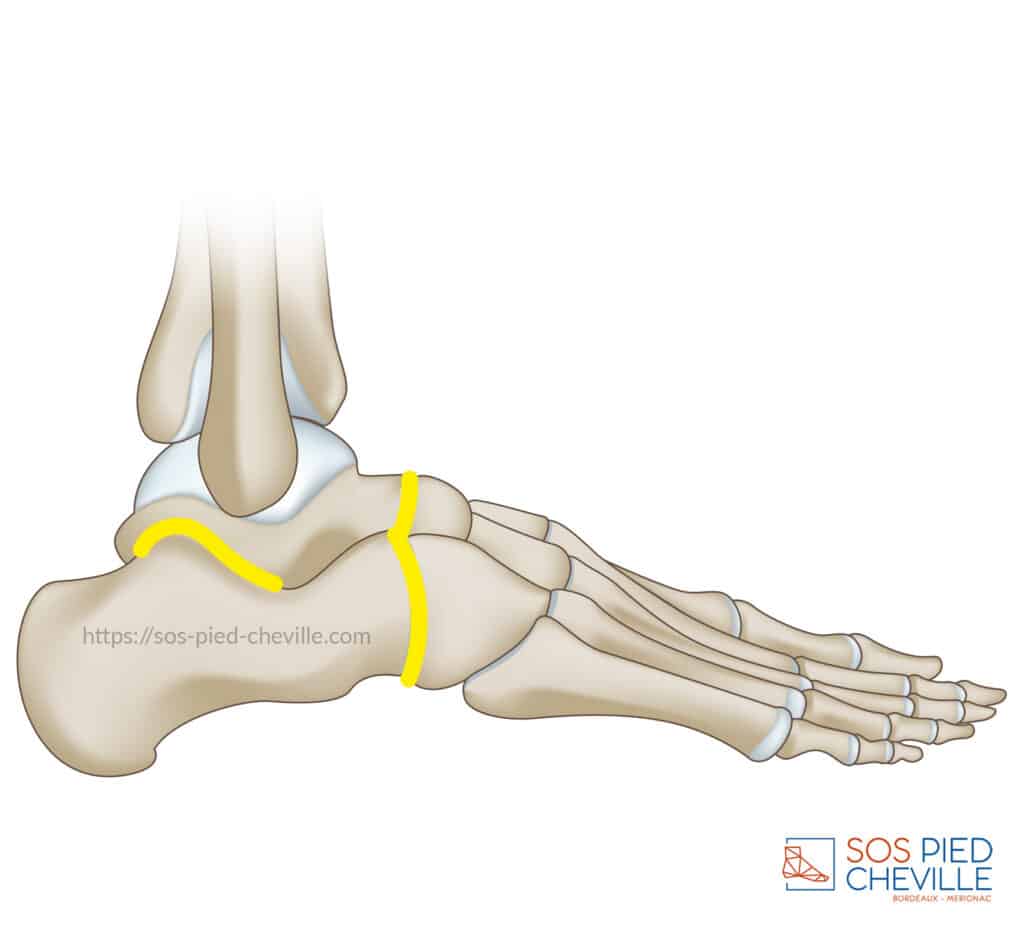 Schéma du squelette du pied de profil : les articulations talo-naviculaire, sous-talienne et calcanéo-cuboïdienne, celles que bloque une arthrodèse péri-talienne, figurées en jaune