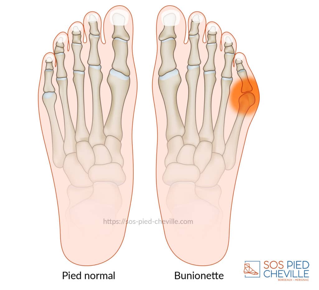 Schémas comparés de deux avant-pieds vus de dessus : à gauche un pied normal, à droite une bunionette, la tête du cinquième métatarsien proéminente et enflammée sur le bord externe