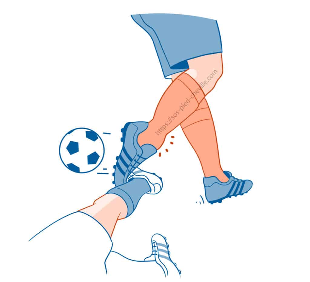 Illustration d’un contact au football : le pied d’un joueur heurte la cheville de son adversaire et provoque une entorse