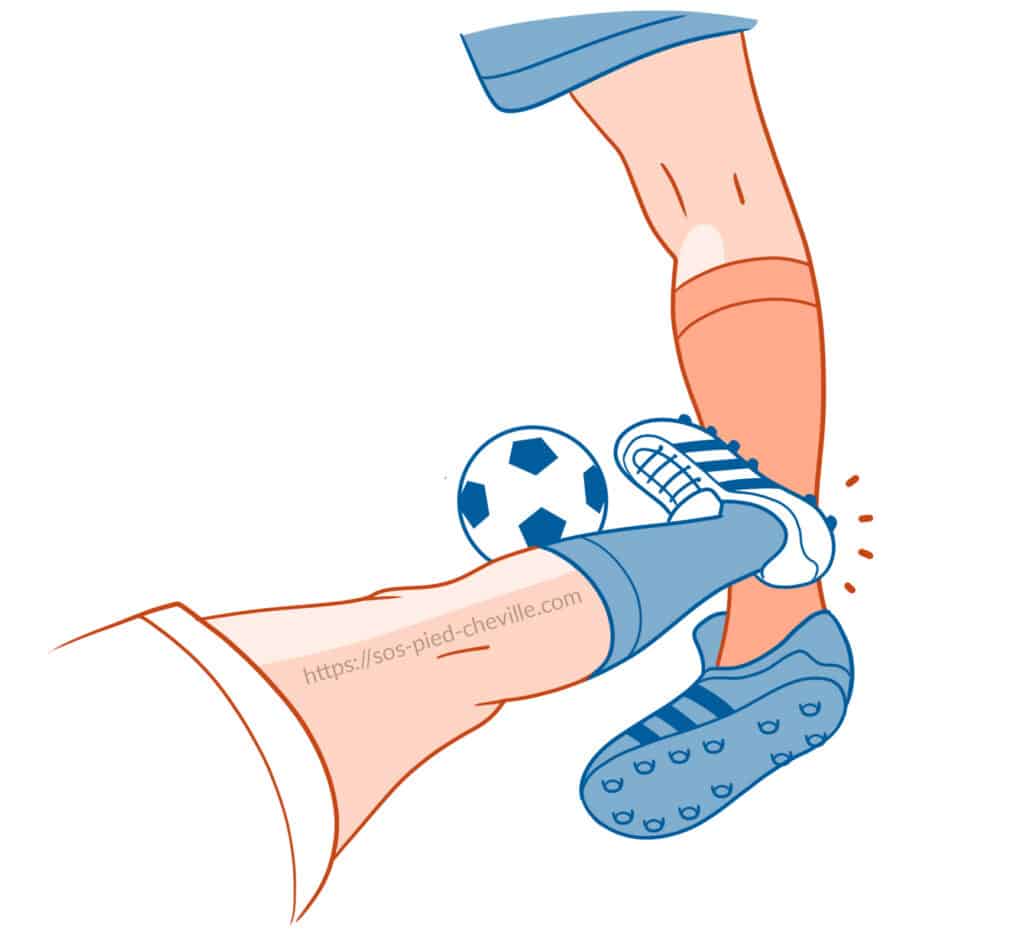 Gros plan d’un contact au football entraînant la torsion de la cheville en inversion