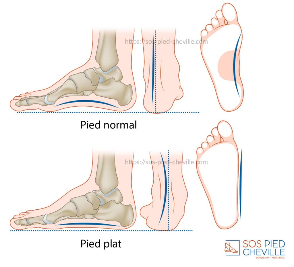 Schémas comparés d’un pied normal et d’un pied plat : vue de profil, vue postérieure et empreinte plantaire montrant l’affaissement de l’arche interne