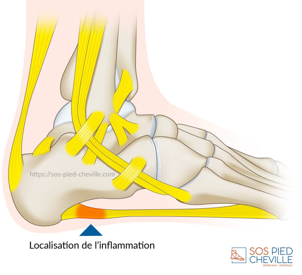 Schéma du pied de profil : l’inflammation siège à l’insertion de l’aponévrose plantaire sur le calcanéum