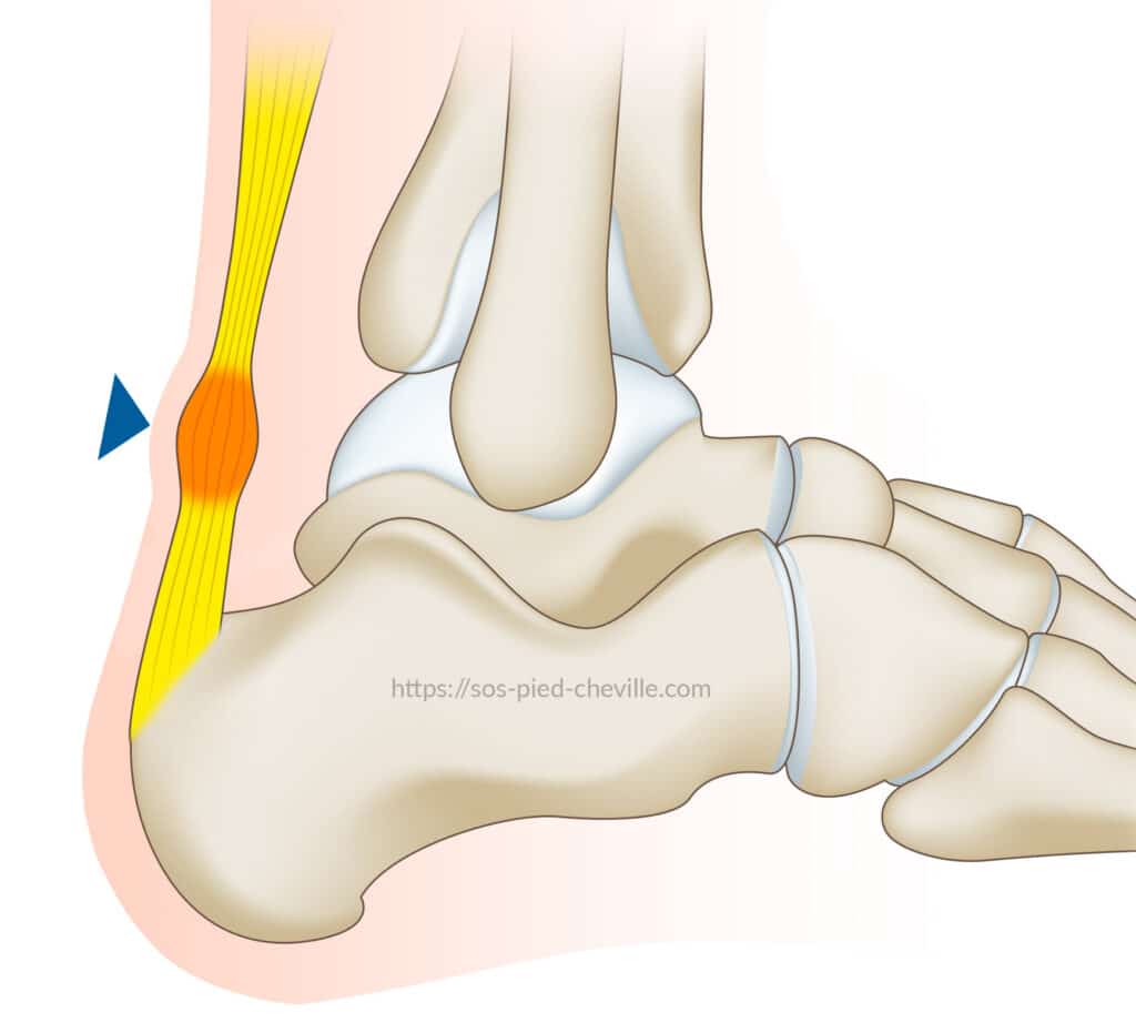 Schéma du tendon d’Achille de profil : le renflement inflammatoire du corps du tendon, quelques centimètres au-dessus du talon
