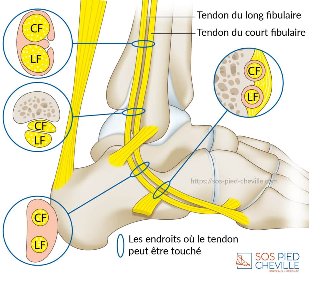 Schéma du pied et de la cheville : les tendons du long et du court fibulaires passant derrière la malléole externe, maintenus par le rétinaculum