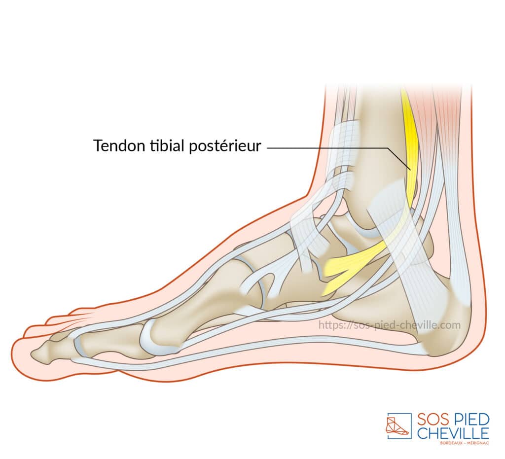 Schéma du pied et de la cheville de profil : le trajet du tendon tibial postérieur, figuré en jaune, et son insertion sur la face inférieure du médio-pied